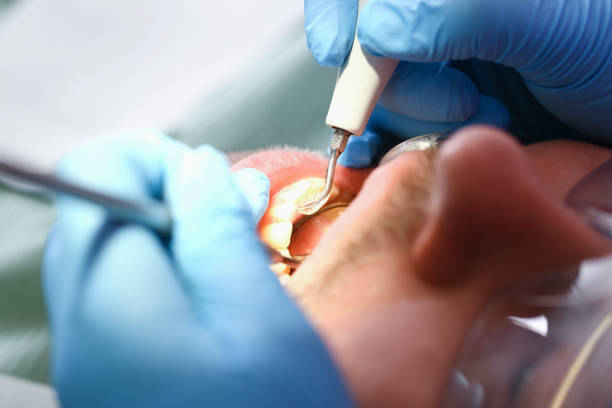 Best Emergency Dentist for Knocked-Out Tooth in Kettering, OH